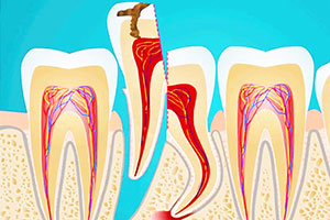 Гемисекция зуба